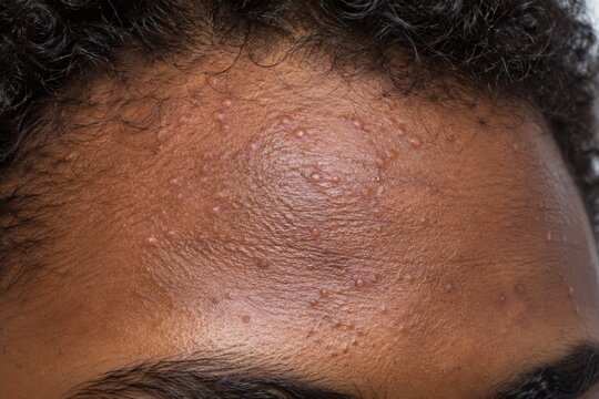 Small follicular papules on forehead skin