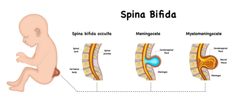 illustration of biology and medical, Illustration of a child with spina bifida, Spina bifida is when a baby's spine and spinal cord, types of spina bifida diagram. The infographic features occulta