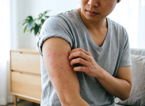 Man scratching itchy skin rash on arm, eczema or allergy concept

