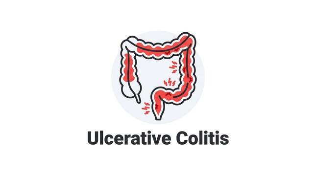 Ulcerative colitis inflammation in colon illustration medical concept