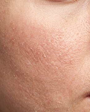 Close-up of dry flaky and peeling facial skin texture