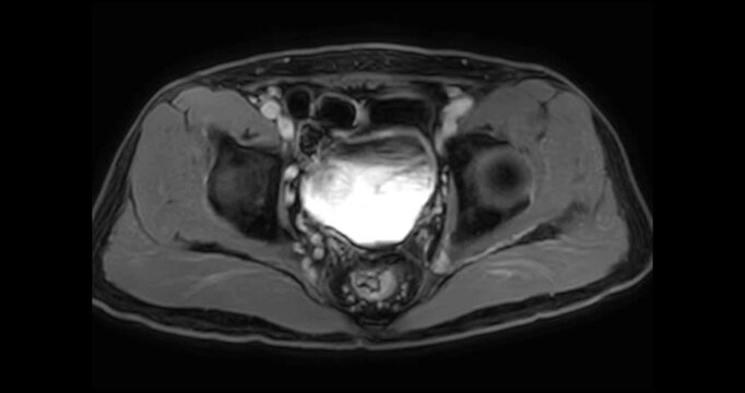 Axial T1 weighted MRI scrolling through the whole male pelvis of a patient with benign prostatic hyperplasia showing bowel bladder and bones.