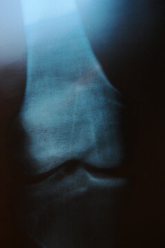Radiograf&iacute;a de rodilla, placa rayos x y radicaci&oacute;n hueso y articulaci&oacute;n rodilla tac menisco y r&oacute;tula en l&aacute;mina de acetato