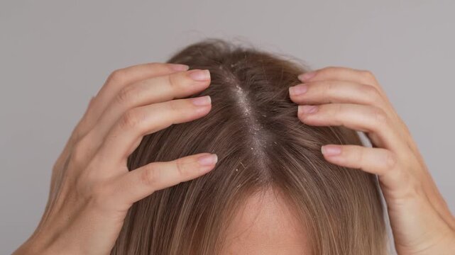 Closeup of a young woman using her fingers to separate blonde hair and reveal numerous white dandruff flakes along the roots. Visible dry scalp, flaking skin and a common dermatological problem