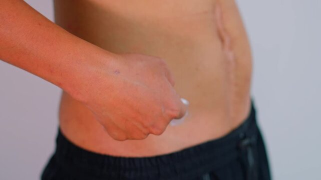 Shirtless man applying cream and massaging ointment onto wound on abdomen