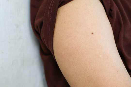 skin texture on the arm of a person who has a small dark brown mole