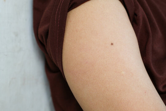 skin texture on the arm of a person who has a small dark brown mole