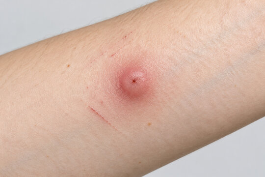 Red swollen mosquito bite on forearm skin, insect bite irritation and allergy