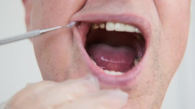 dentist prosthesis examining man Patient mouth, open mouth Mixed natural and prosthetic teeth and gums, dental checkup restoration, oral inspection, stomatology healthcare, medical modern dentistry