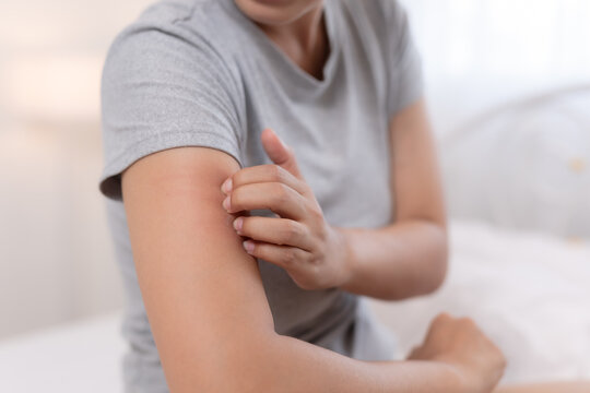 Unhappy woman scratching itchy arm skin indoors suffering from painful allergy rash irritation during daytime discomfort