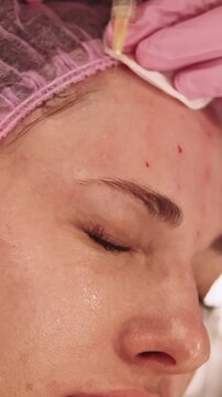 Vertical video. Dermal injection. Facial care. Cosmetologist female hand using neurotoxin filler in aesthetic medicine clinic beauty for face treatment.