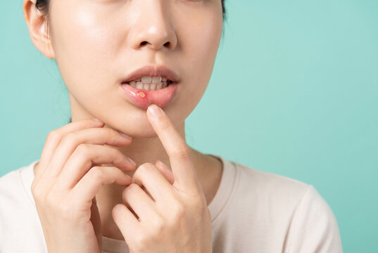 口内炎の痛みに悩む若い女性のクローズアップ、口腔トラブル・医薬品広告向け