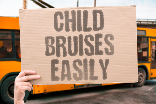 "Child bruises easily" Easy bruising worries parents. CHILDHOOD. CANCER. SYMPTOMS. BRUISES. PARENTS.