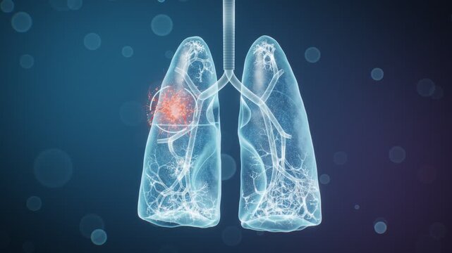 Lung Cancer Lesion 3D Medical Animation Translucent Lungs CT Scan Spiculated Tumor