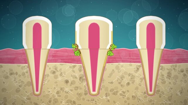 Gum disease animation, tooth cross section, plaque under the gumline, gums recede, then healthy after dental cleaning