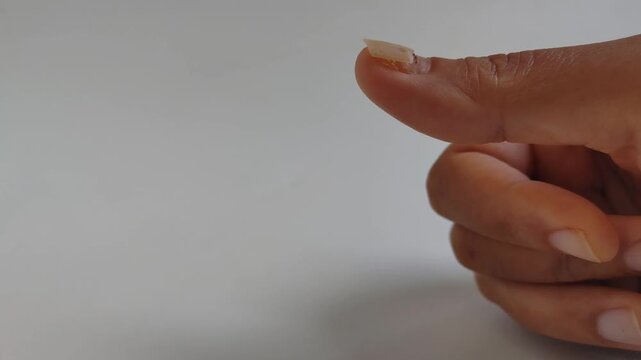 Close-up of a thumb with a damaged and healing nail against a white background