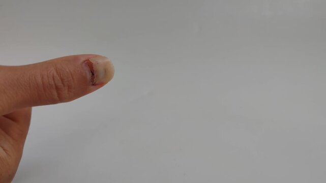 Close-up of a thumb with a damaged and healing nail against a white background