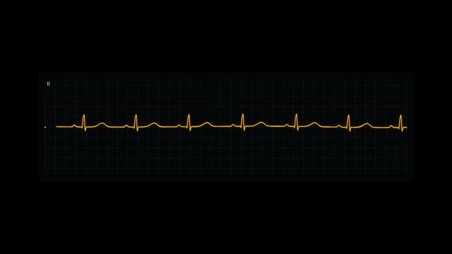 Heart monitor torsades de pointes degenerating into VF cardiac arrest