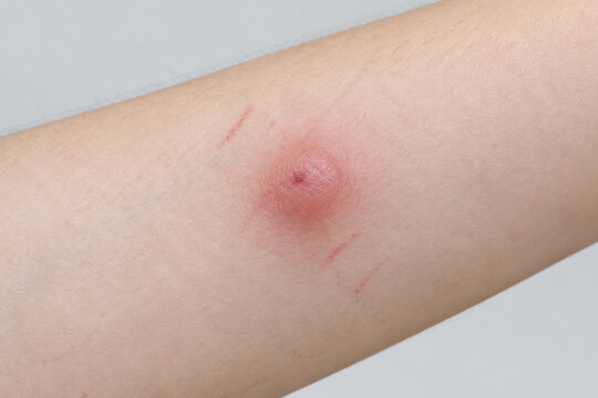 Red swollen mosquito bite on forearm skin, insect bite irritation and allergy