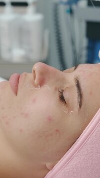 esthetician wearing green gloves applies white alginate facial mask over mesh support on acne-prone young face