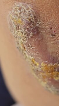 Detailed macro view of an infected skin wound covered with a rough yellowish scab and dried pus highlighting the natural healing process of human epidermal tissue