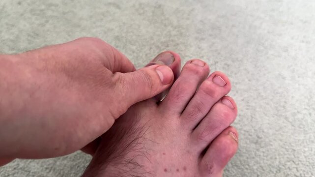 Close-up of a male hand examining a swollen toe with visible bruising on a foot, showcasing the progression of edema in a well-lit indoor setting