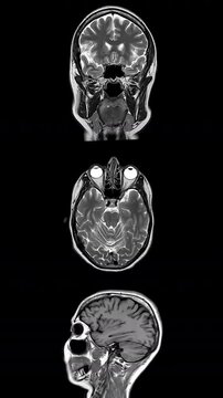Stop Motion Gray Scale Magnetic Resonance Tomograms Showing Axial Coronal And Sagittal Sections Of Healthy Human Brain