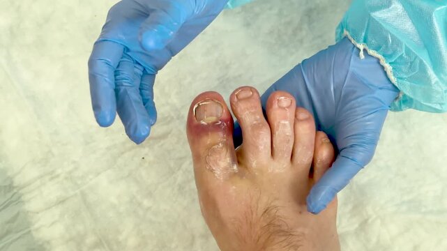 Medical professional in blue gloves examines injured foot with visible hematoma, focusing on the affected toe and surrounding skin in a clinical setting