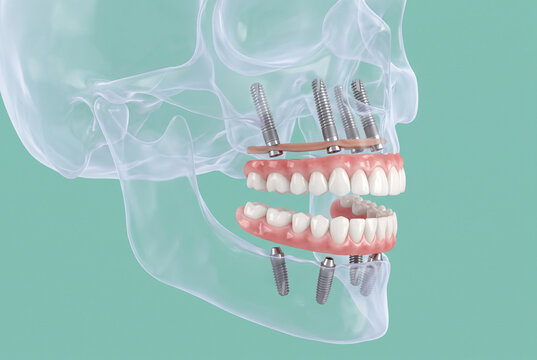 3D illustration of transparent human skull with All-on-4 dental implants, upper and lower full arch denture on titanium screws, implant dentistry concept on teal background