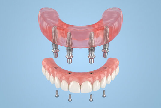 3D illustration of All-on-4 dental implant system exploded view with four titanium abutments, full arch hybrid denture and retaining screws on blue background