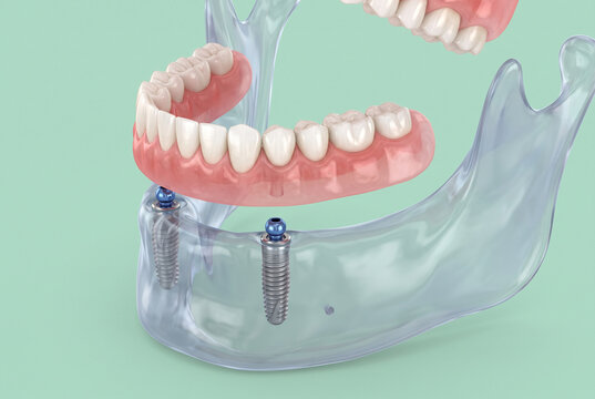 3D illustration of mandibular implant-retained overdenture with two ball attachments in transparent jawbone, removable lower denture on mint green background