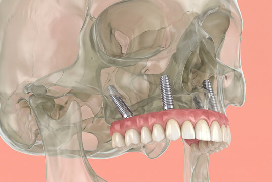 3D illustration of transparent human skull with four maxillary dental implants supporting full arch fixed denture on coral pink background, implant dentistry concept