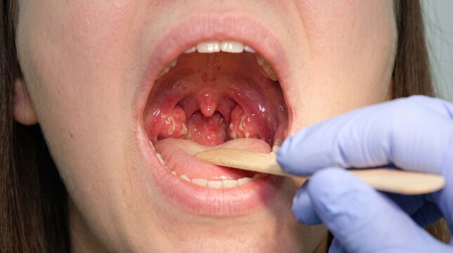 Medical examination of a patient with sore throat and infected tonsils. Healthcare professional checking oral cavity and inflamed tonsillitis for clinical diagnosis and treatment.