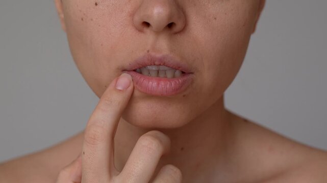 Young woman pointing at her lower lip while examining dryness and flaking. Concept of chapped lips, irritation, dehydration, tenderness and facial skincare issue