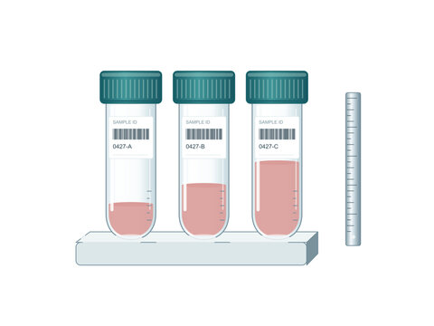 Laboratory sample tubes with different fill volumes in a rack