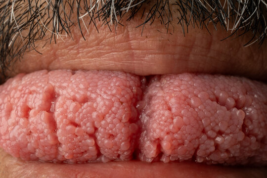 Macro of Human Tongue Surface Showing Fungiform and Filiform Papillae