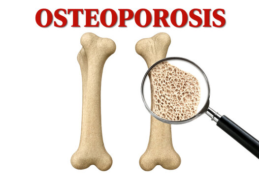 Close up illustration of bone structure highlighting osteoporosis and porous bone tissue under magnification