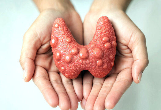 Hands holding detailed medical model of human thyroid gland with nodules or goiter appearance