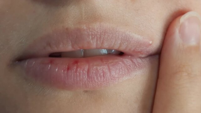 Chapped lips receive gentle touch from fingertip, with dry skin and slight redness visible. Close examination highlights lip health, discomfort, and need for careful moisturizing care.
