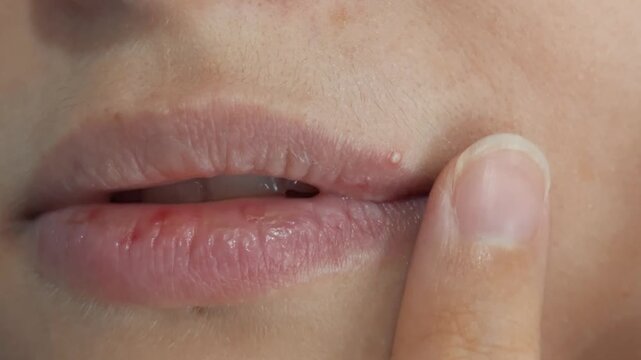 Close up woman touches small upper lip blemish while inspecting her mouth. Chapped, reddened lips part slightly during careful self examination, conveying worry about possible cold sore.