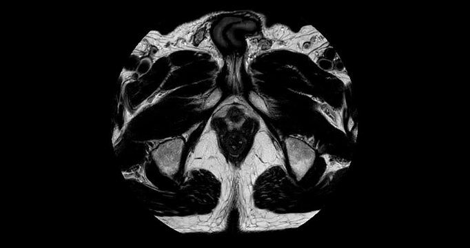 Axial T2 weighted MRI of the prostate with heterogeneous encapsulated BPH nodules and linear low signal in both peripheral zones suggesting prostatitis.
