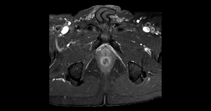 Axial fat suppressed MRI scrolling through a prostate gland with benign prostatic hyperplasia and bright pelvic vessels on a black background.