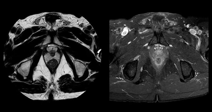 Side by side axial prostate MRI comparing T2 weighted and fat suppressed images of benign prostatic hyperplasia with peripheral zone prostatitis.