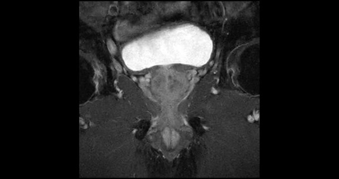 Coronal fat suppressed MRI scrolling through the bright urinary bladder and an enlarged prostate gland with benign prostatic hyperplasia.