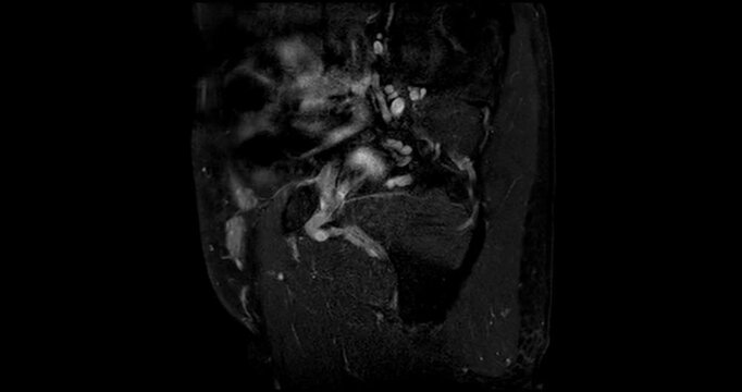 Sagittal fat suppressed MRI scrolling through the male pelvis showing benign prostatic hyperplasia below the bladder with the rectum behind.