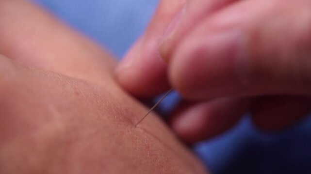 Acupuncture Moxibustion Oriental Medicine Korean Medicine Doctor Patient Treatment Therapy Clinic Korea 침 뜸 한의학 한의사 한의원 진료 치료 침술 뜸치료 혈자리 동의보감 한국