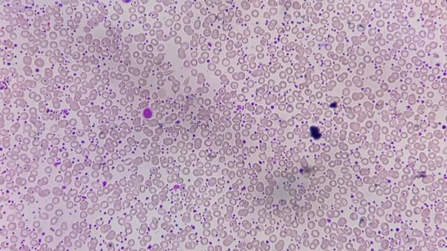 Thrombocytosis. Platelet count increased in number. Microscopic footage of complete blood count (CBC). White blood cells, Red blood cells, Neutrophils. 