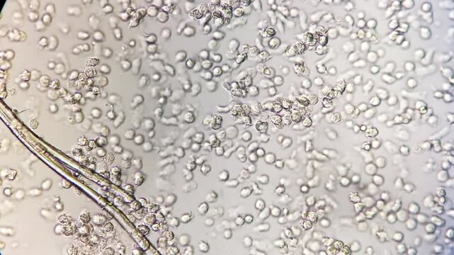 Microscopic footage of the urinalysis showing plenty Pus cells. Pus cells in urine under microscopy. 