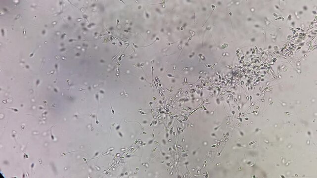Microscopic footage of semen normozoospermia sperm count. Normal semen analysis on microscopic examination.