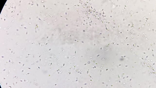 Microscopic footage of semen normozoospermia sperm count. Normal semen analysis on microscopic examination.